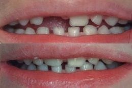 Pediatric Dentist 6 Before & After Pediatric Dentistry in Dubai