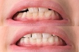 Pediatric Dentist 5 Before & After Pediatric Dentistry