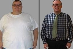 Revision Bariatric Surgery 4 Before & After Revision Bariatric Surgery