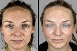 Salmon DNA Injection in Dubai 4 Before & After Salmon DNA Injection