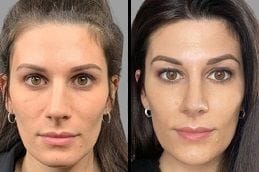 Before After Sculptra Fillers in Dubai