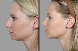 Septorhinoplasty 4 Before & After Septorhinoplasty in Dubai