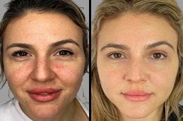 Skin Booster Injections 6 Before & After Skin Booster Injections