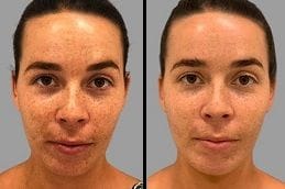 Before & After Skin Pigmentation Silicon Oasis