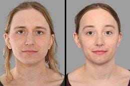 Before After Sunekos Injections in Dubai