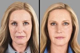 Before After Sunekos Injections