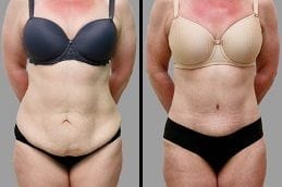 Tummy Tuck | Abdominoplasty 5 Before & After Tummy Tuck in Dubai