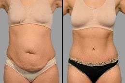 Tummy Tuck | Abdominoplasty 6 Before & After Tummy Tuck