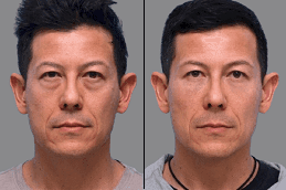 Voluma Filler 6 Before & After Voluma Filler in Dubai