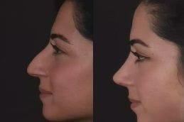 Alarplasty in Dubai 4 Before and After Alarplasty in Dubai