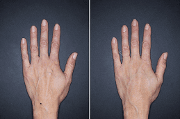 Hand Rejuvenation 4 Before and After Hand Rejuvenation
