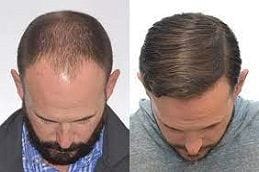 Before and After Hybrid Hair Transplant