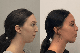 Before and After Jawline Contouring