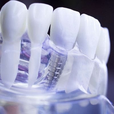 Benefit of Dental Implants