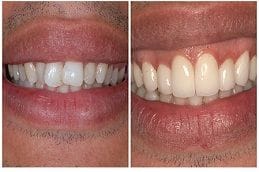 Ceramic Crowns 4 Best Ceramic Crowns Dubai
