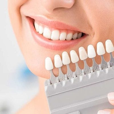 Best Composite Veneers Only in 600 AED