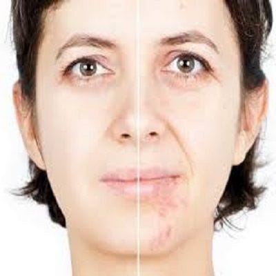 Best Face Scar Removal Surgery