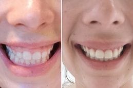 Gingivitis Treatment 4 Best Gingivitis in Abu Dhabi