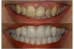 Gingivitis Treatment 5 Best Gingivitis in Dubai & Abu Dhabi