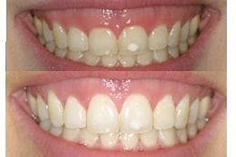 Gingivitis Treatment 6 Best Gingivitis in Dubai
