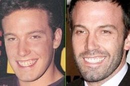 Hollywood Smile Makeover Dubai 4 Best Hollywood Smile Makeover Dubai