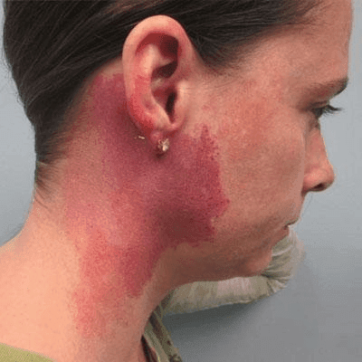 Best Laser Treatment For Port Wine Stains in Dubai 1 Best Laser Treatment For Port wine Stains in Dubai