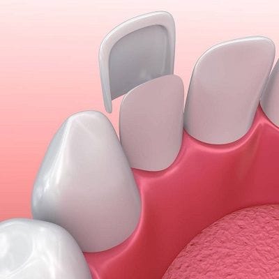Best Porcelain Veneers Dubai Only in 999 AED