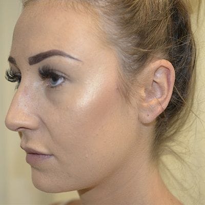 Best Rhinoplasty Surgeon