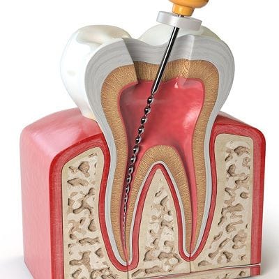 Best Root Canal Endodontic Treatment Clinic in Dubai Abu Dhabi Cost