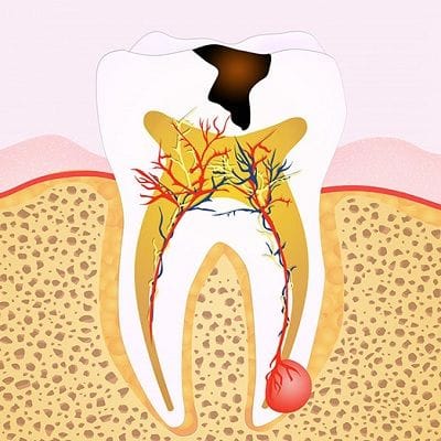 Best Root Canal Treatment in Dubai Abu Dhabi