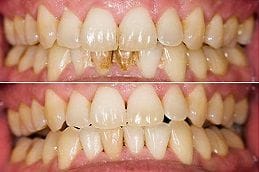 Best Teeth Cleaning Abu Dhabi