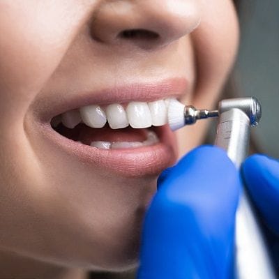Teeth Cleaning in Dubai