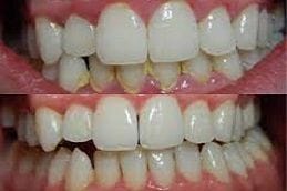 Best Teeth Cleaning in Dubai & Abu Dhabi