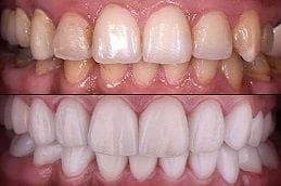 Before & After Teeth Cleaning in UAE