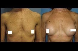 Breast Lift Surgery 6 Best breast-lift Clinic in Dubai