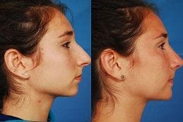 Chin Augmentation 12 Best chin-augmentation Clinic in Dubai