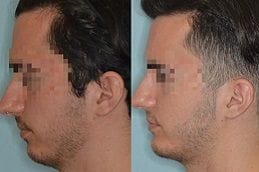 Best-chin-augmentation-in-Abu-Dhabi