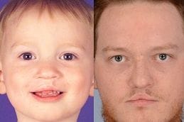 Cleft Lip Surgery - Craniofacial 5 Best cleft-craniofacial-surgery Clinic in Dubai