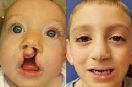 Cleft Lip Surgery - Craniofacial 4 Best cleft-craniofacial-surgery in Abu Dhabi