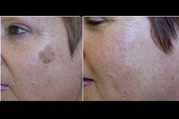 Cryosurgery – Cryotherapy 1 Best cryosurgery-cryotherapy in Abu Dhabi
