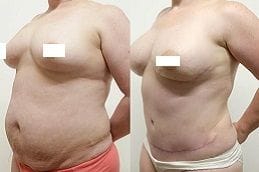 DIEP Flap Breast Reconstruction 6 Best diep-flap-breast-reconstruction Clinic in Dubai