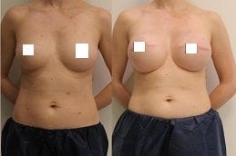 DIEP Flap Breast Reconstruction 4 Best diep-flap-breast-reconstruction in Abu Dhabi