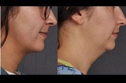 Double Chin Liposuction 6 Best double-chin-liposuction in Abu Dhabi