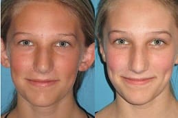Ear Reshaping Surgery | Otoplasty 4 Best ear-surgery-otoplasty in Abu Dhabi