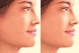 Facial Scar Revision 4 Best facial-scar-revision Clinic in Dubai
