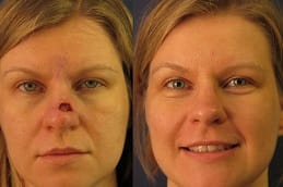 Facial Scar Revision 5 Best facial-scar-revision in Abu Dhabi