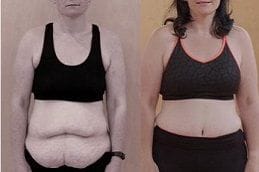 Best gastric-bypass in Abu Dhabi