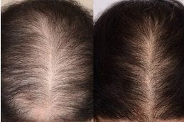 Hair Fall Treatments 4 Best hair-fall-treatments in dubai