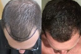 FUT & FUE Hair Transplant Al Ain 2 Best hair-transplant-al-ain in Abu Dhabi