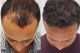 FUT & FUE Hair Transplant Al Ain 3 Best hair-transplant-al-ain in Abu Dhabi